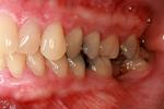 Traditional-Periodontal-Therapy-Before-Image