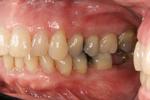 Traditional-Periodontal-Therapy-After-Image